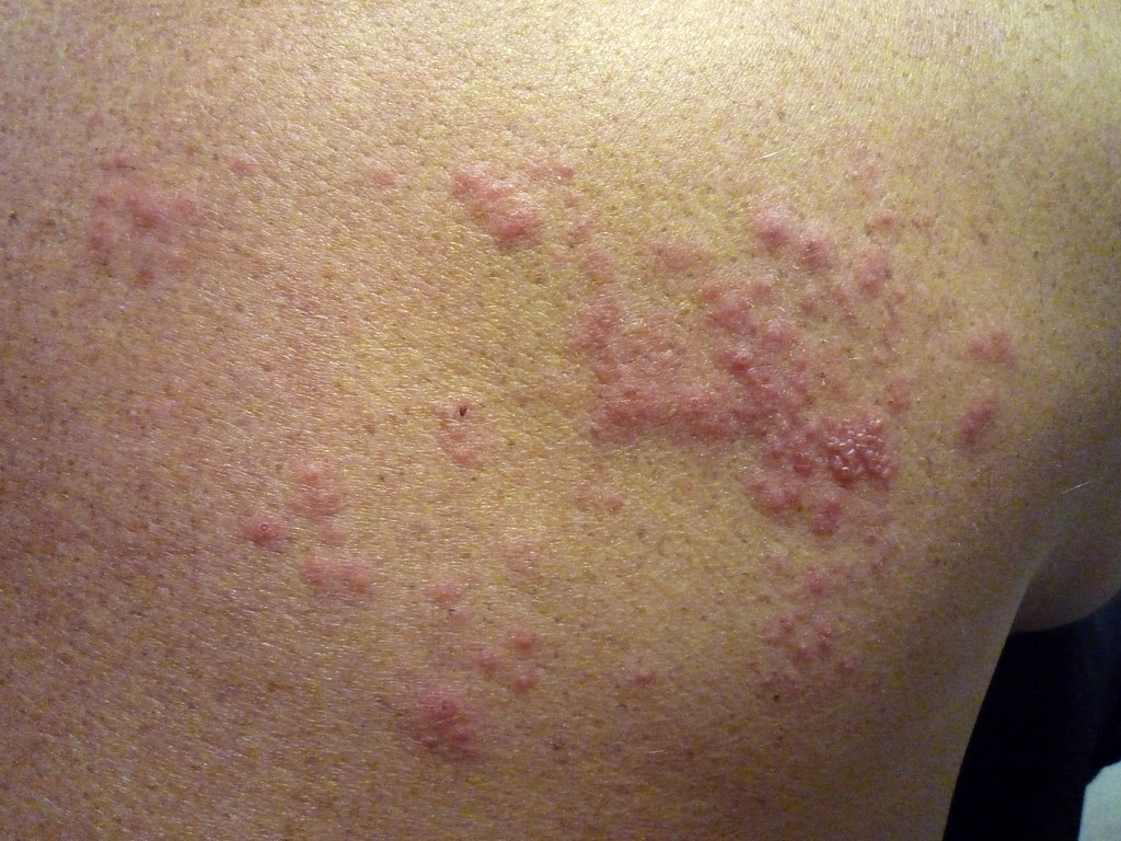 herpes contraction
